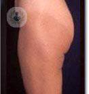 il-lifting-dei-glutei-l-intervento-perfetto-per-migliorare-le-imperfezioni immagine dell'articolo
