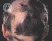 Cause e rimedi per i problemi di alopecia