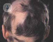 cause-e-rimedi-per-i-problemi-di-alopecia immagine dell'articolo