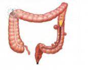I diverticoli del colon: prevenzione, diagnosi e trattamenti