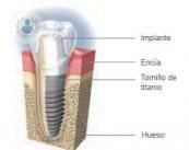 Cosa sono e perché si utilizzano le protesi dentarie 