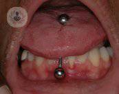 i-problemi-che-causano-i-piercing-sulla-bocca immagine dell'articolo