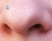 Rinoplastica: la chirurgia del naso con risultati naturali