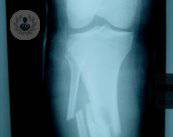 nuove-procedure-per-curare-le-lesioni-ossee immagine dell'articolo