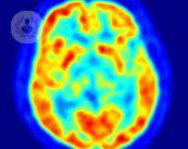 cos-e-la-stimolazione-cerebrale-profonda immagine dell'articolo
