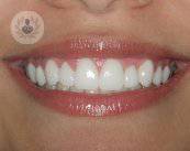 denti-bianchi-la-soluzione-ideale-le-faccette-dentali-e-lumineers immagine dell'articolo