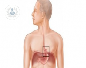 la-giusta-dieta-per-curare-l-ernia-iatale immagine dell'articolo