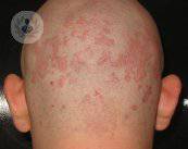 La dermatite seborroica: cause e trattamento