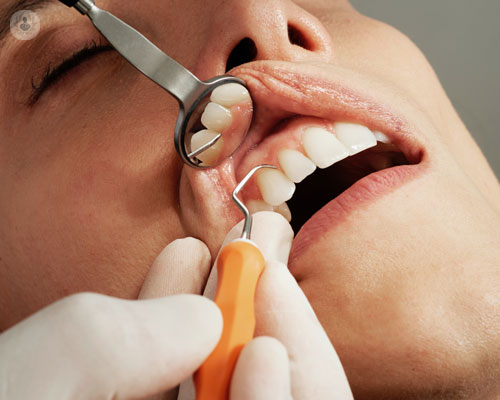 Gli impianti dentali osteointegrati 