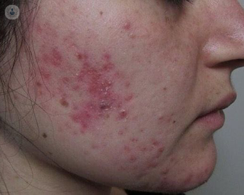Quando l'acne si trasforma in un problema serio