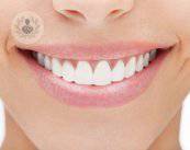 Killer questions: tutto quello che dovresti sapere sugli impianti dentali