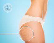 liposuzione-come-si-svolge-l-operazione immagine dell'articolo