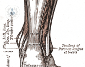 Tipologie di lesioni al tendine di Achille
