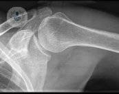 artroscopia-chirurgia-mini-invasiva-per-le-lesioni-della-spalla immagine dell'articolo