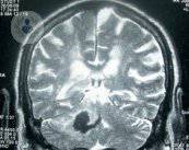 le-domande-piu-comuni-sull-embolia-cerebrale immagine dell'articolo