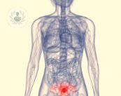 Novità nella diagnosi dei tumori ginecologici