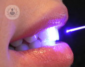 il-laser-piu-utile-per-la-chirurgia-odontoiatrica immagine dell'articolo