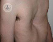 pectus-excavatum-cause-sintomi-e-trattamento immagine dell'articolo