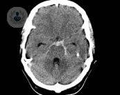 emorragia-cerebrale-i-sintomi-e-le-cause immagine dell'articolo