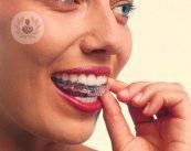 invisalign-ortodonzia-invisibile-per-correggere-la-malocclusione-dentale immagine dell'articolo