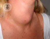 Aumento della ghiandola tiroidea: cause, sintomi e trattamento