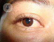Sconfiggere la retinopatia diabetica con la diagnosi precoce