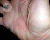 l-orticaria-sintomi-e-trattamento immagine dell'articolo