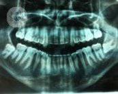 I dubbi più comuni sulle inclusioni dentali