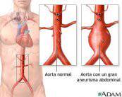 Aneurismi aortici: come individuarli e trattarli