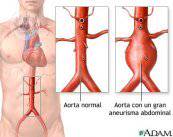 aneurismi-aortici-come-individuarli-e-trattarli immagine dell'articolo