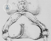 l-asimmetria-mammaria-cos-e-e-come-si-risolve immagine dell'articolo
