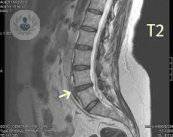 la-discopatia-una-patologia-che-insorge-con-l-avanzare-dell-eta immagine dell'articolo