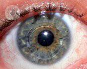cheratocono-una-malattia-degenerativa-della-cornea immagine dell'articolo