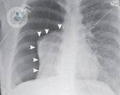 pneumotorace-tutto-quello-che-c-e-da-spere-su-questa-patologia immagine dell'articolo
