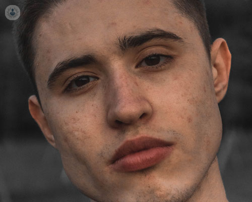 acne-diagnosi-cause-e-trattamenti immagine dell'articolo