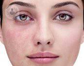 rosacea-prima-e-dopo-il-trattamento immagine dell'articolo