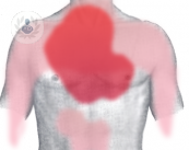 ischemia-acuta-periferica-sintomi-e-trattamenti immagine dell'articolo