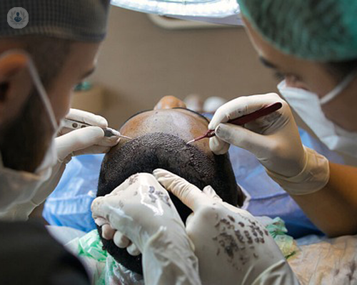 il-nuovo-metodo-fue-per-il-trapianto-di-capelli immagine dell'articolo