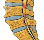 La storia di un paziente con stenosi del canale spinale
