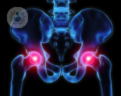 È possibile individuare e prevenire l'artrosi dell'anca?