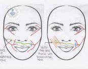 Paralisi facciale: che cos'è e come si cura?