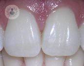 endodonzia-cause-trattamenti-e-possibili-rischi immagine dell'articolo