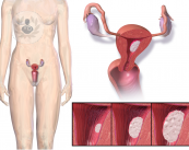 la-prevenzione-e-fondamentale-nella-lotta-contro-i-tumori-femminili immagine dell'articolo
