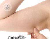 laserlipolisi-la-liposcultura-laser-per-eliminare-il-grasso-delle-braccia immagine dell'articolo