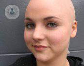 Definizione dell'alopecia androgenetica femminile