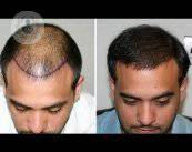 autotrapianto-di-capelli-fue-la-soluzione-definitiva-alla-caduta-dei-capelli immagine dell'articolo