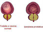 il-laser-verde-come-strumento-per-sconfiggere-l-iperplasia-benigna-alla-prostata immagine dell'articolo