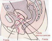 Interventi chirurgici per le diverse tipologie di fistole anali 