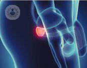 Chirurgia robotica come soluzione per il cancro alla prostata