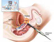 la-chirurgia-robotica-nell-esecuzione-della-prostatectomia-radicale immagine dell'articolo